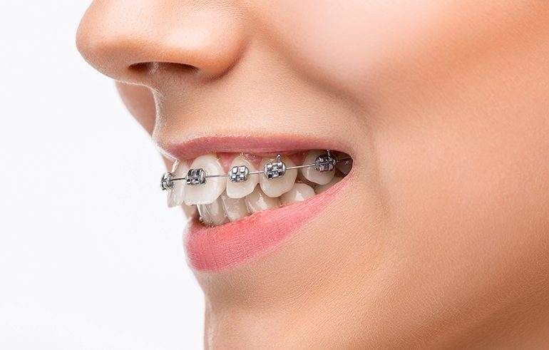 ortoonti diş teli tedavisi